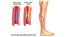 Biểu hiện bệnh động mạch chi dưới cần cảnh giác