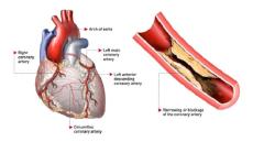 Bệnh co thắt động mạch vành và những điều cần biết