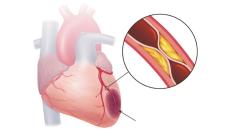 Bệnh mạch vành ở người cao tuổi - nguy cơ và giải pháp