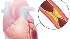 Bệnh mạch vành ở người cao tuổi - nguy cơ và giải pháp