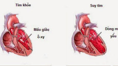Chăm sóc bệnh nhân suy tim thế nào là đúng cách?