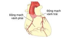 Khám và hỗ trợ chữa bệnh mạch vành ở đâu hiệu quả