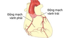 Khám và hỗ trợ chữa bệnh mạch vành ở đâu hiệu quả