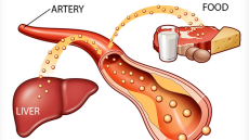 Mối liên hệ giữa cholesterol và bệnh tim mạch