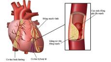 Hiểu đầy đủ về nguyên nhân của bệnh thiếu máu cơ tim