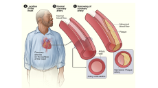 Nhận biết và phòng ngừa bệnh mạch vành