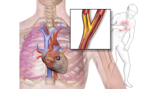 Bệnh thiếu máu cơ tim