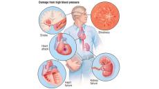 Ảnh hưởng của tăng huyết áp với cơ thể