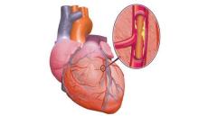 Tại sao rối loạn lipid máu gây nguy hiểm? (Phần 3)