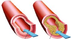 Bệnh rối loạn mỡ máu có nguy hiểm không?