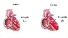 Bệnh suy tim không nên ăn gì? Chế độ ăn hợp lý khi bị suy tim