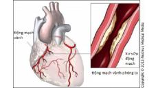 Cây dong riềng đỏ có hiệu quả không khi dùng cho bệnh mạch vành?