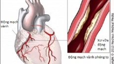 Cây dong riềng đỏ có hiệu quả không khi dùng cho bệnh mạch vành?