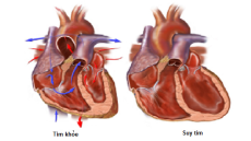 Dấu hiệu cho thấy có thể bạn đang bị suy tim