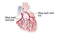 Đau thắt ngực là biểu hiện của bệnh nhồi máu cơ tim