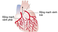 Đau thắt ngực là biểu hiện của bệnh nhồi máu cơ tim