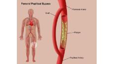 Giải pháp cho bệnh động mạch ngoại biên