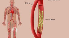 Giải pháp cho bệnh động mạch ngoại biên