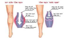 Giải pháp cho bệnh suy giãn tĩnh mạch chân