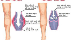 Giải pháp cho bệnh suy giãn tĩnh mạch chân