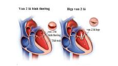 Tư vấn: Hẹp van tim hai lá có sinh con được không?