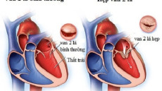 Tư vấn: Hẹp van tim hai lá có sinh con được không?