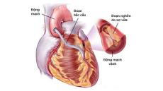 Mổ bắc cầu mạch vành là gì và cần làm gì sau mổ?