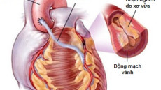 Mổ bắc cầu mạch vành là gì và cần làm gì sau mổ?