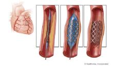 Tư vấn: Nếu đặt 1 stent có thể phải đặt những stent tiếp theo không?