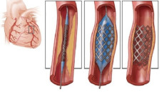 Tư vấn: Nếu đặt 1 stent có thể phải đặt những stent tiếp theo không?