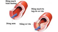 Nguyên nhân xơ vữa động mạch theo Y Học Cổ Truyền