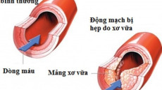 Nguyên nhân xơ vữa động mạch theo Y Học Cổ Truyền