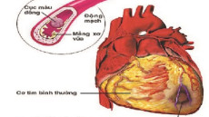 Lí giải các chỉ số mỡ máu (Phần 2)