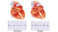 Tư vấn: Rung nhĩ có nguy hiểm không?