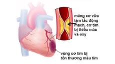 Sự khác nhau giữa nhồi máu cơ tim và suy tim