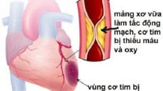 Sự khác nhau giữa nhồi máu cơ tim và suy tim