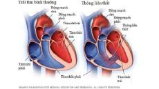 Tổng quan về bệnh thông liên thất