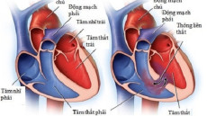 Tổng quan về bệnh thông liên thất