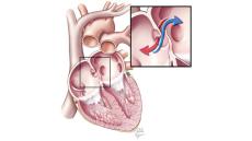 Tổng quan về bệnh thông liên nhĩ