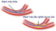 Bệnh xơ vữa động mạch nên dùng thuốc như thế nào?