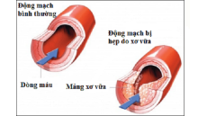 Yếu tố gây nên bệnh xơ vữa động mạch