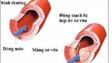 Yếu tố gây nên bệnh xơ vữa động mạch
