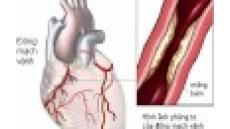 Phát hiện sớm và phòng ngừa bệnh mạch vành