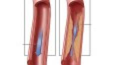 Nguyên nhân gây bệnh mạch vành?