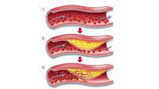 Tư vấn: Có khi nào bị bệnh động mạch vành không đau ngực không?