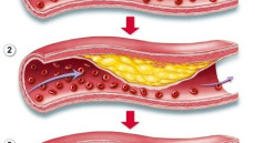 Tư vấn: Có khi nào bị bệnh động mạch vành không đau ngực không?