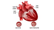 Tư vấn: Bệnh van tim thường là những bệnh như thế nào?