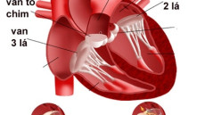 Tư vấn: Bệnh van tim thường là những bệnh như thế nào?