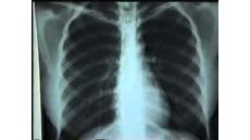 Tư vấn: Khó thở khi làm việc nặng có phải bị bệnh suy tim không?