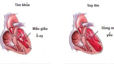Tư vấn: Tìm hiểu về nguyên nhân suy tim